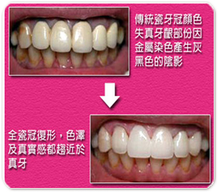 薏安牙醫 全瓷假牙