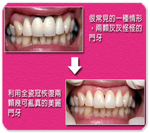 薏安牙醫 全瓷假牙